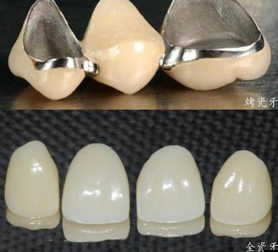 烤瓷牙和全瓷牙价格，探索学习与变化的魅力之旅