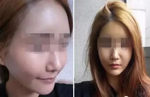 揭秘明星玻尿酸的秘密，美丽背后的真相探索！